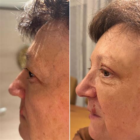 Eredmények a botoxos szemöldökemelés után