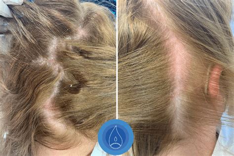 Kép: Oxygens Hair oxigénterápiás kezelése