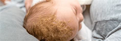 Koszmó a babák fejbőrén