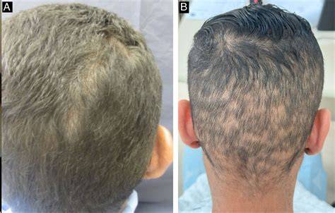 parieto-occipital moth-eaten alopecia