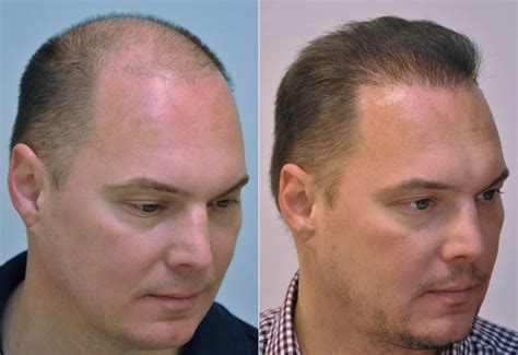 Hajbeültetés utáni mezoterápia eredményei