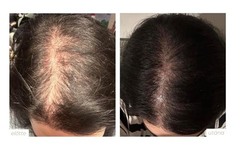 Mezoterápia hajhullás ellen: Kezelés előtt és után