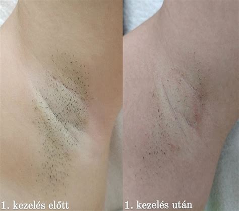 Lézeres szőrtelenítés előtti és utáni állapot