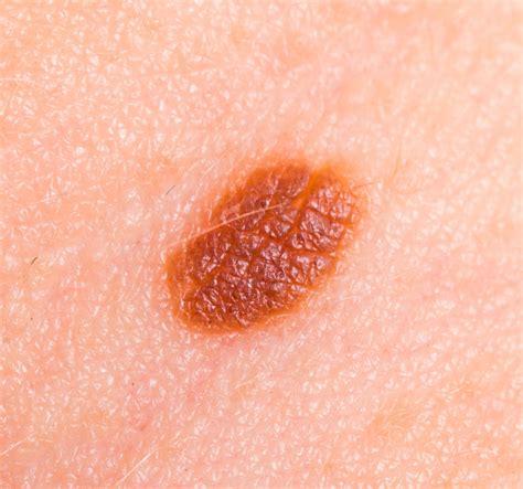 Anyajegyek dermatoszkópos vizsgálata