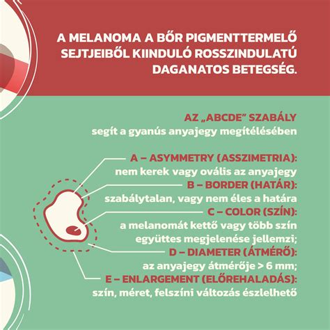 Az ABCDE szabály az anyajegyek ellenőrzésére