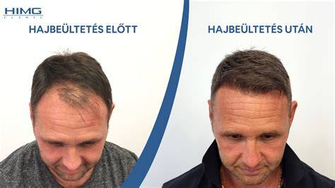 hajbeültetés eljárások vizuális áttekintése