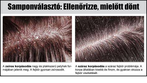Diagram: korpásodás típusai és megfelelő sampon kiválasztása