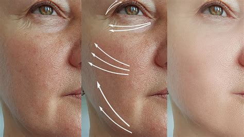 Infografika a ráncok csökkenéséről és a bőr feszességének javulásáról