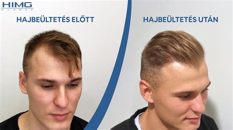 Hajbeültetés előtt és után
