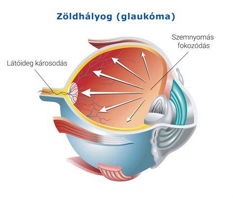 Infografika a glaukóma típusairól és a kezelési lehetőségekről