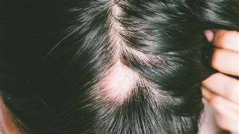 Az alopecia areata foltos mintázata
