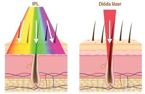 Infografika: IPL vs. dióda lézer összehasonlítás