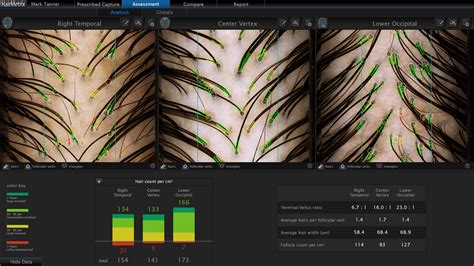 Canfield HairMetrix