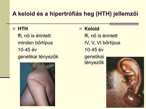Heg típusok: átrófiás, hipertrófiás, keloid
