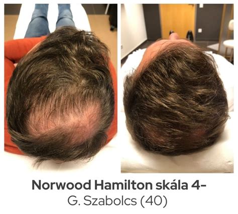 Idővonal a lézeres hajkezelés eredményeinek megjelenéséről