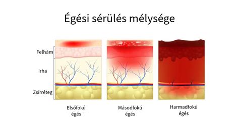 Az albinizmus tünetei és típusai