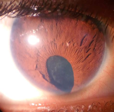 Veleszületett coloboma az íriszen