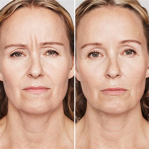 Hialuronsavas arcfeltöltés eredménye