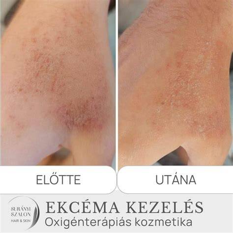 Oxigénterápia folyamatábrája