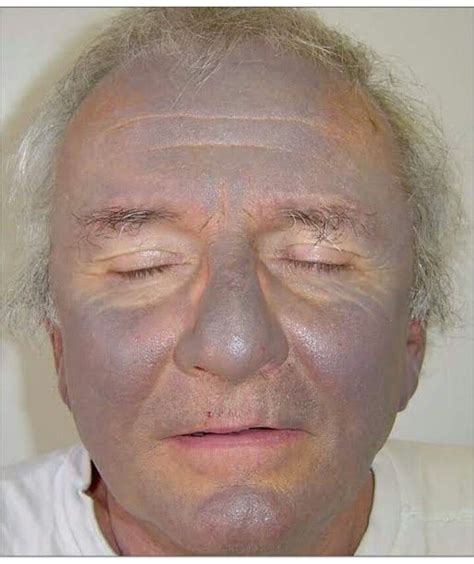 Argyria, ezüst felhalmozódásának tünete