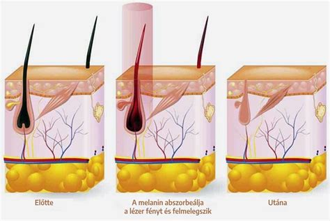 Napvédelem fontossága lézeres szőrtelenítés után
