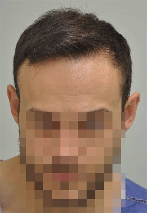 adóhely FUE hajbeültetés előtte után