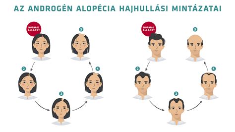 Különböző hajhullási minták férfiaknál és nőknél