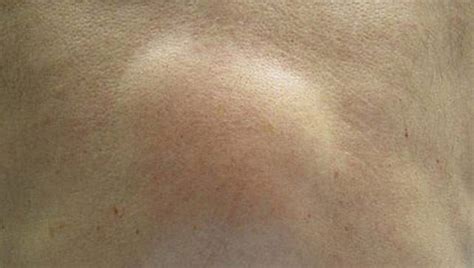 Bőr alatti csomó kutyán