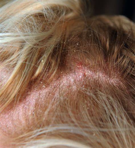 Infografika: Seborrhoeás dermatitisz patogenezise és kezelési logika