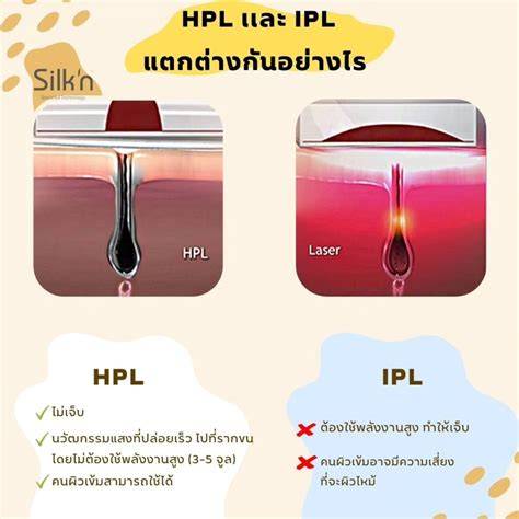 Infografika: IPL, lézer, HPL összehasonlítás