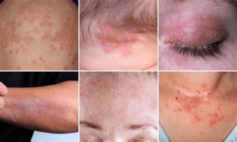 Vörös csík a seb körül, ami nyirokérgyulladást jelez