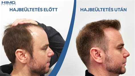 Hajbeültetés utáni 6 hónap fotó