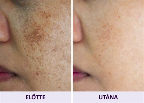 Napfény okozta pigmentfoltok az arcon