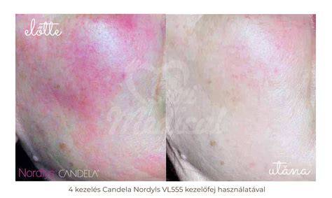 ROSACEA elleni IPL kezelés eredménye