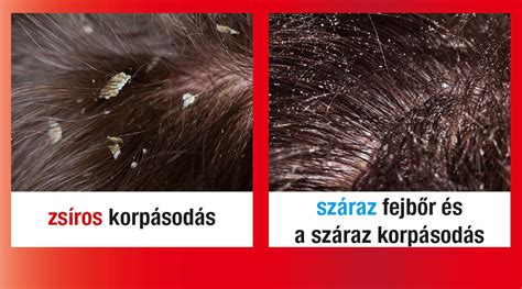 A korpásodás és a viszkető fejbőr ábrázolása