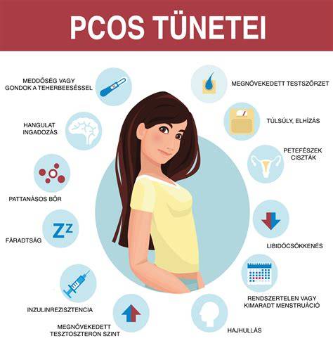 Infografika: PCOS és hajhullás összefüggései - hormonális egyensúly, inzulinrezisztencia, gyulladás, DHT