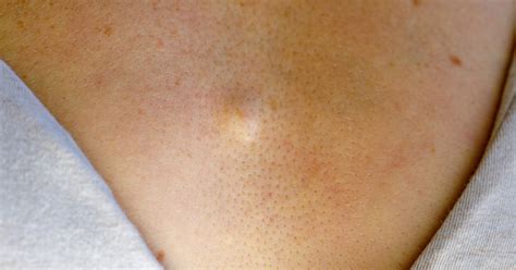 Infografika: Atheroma és lipóma összehasonlítása