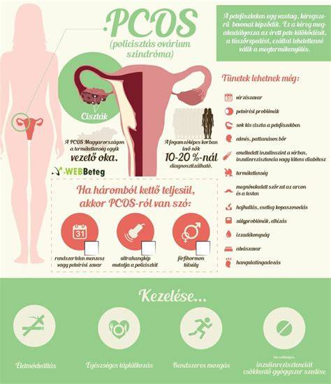 Infografika: PCOS pathofizológia és kezelési megközelítések