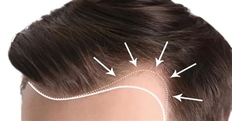 hajvonal visszahúzódása férfiaknál