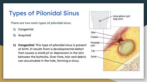 A pilonidalis sinus (sipoly) okai és megelőzése