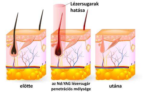 diagram a szőrtelenítés módszereiről