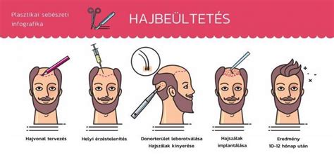 Infografika: Hogyan működik a hajbeültetés (FUE módszer) - lépések