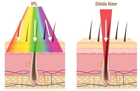 Infografika: IPL vs. lézer szőrtelenítés