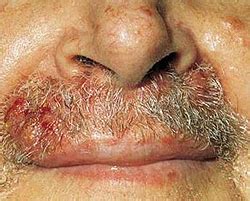 Szőrtüszőgyulladás tünetei