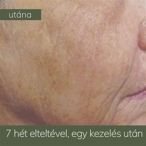 Lézeres bőrmegújítás folyamata