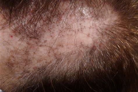 gyors vizuális ábrázolás alopecia típusokról