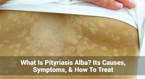 Infografika a pityriasis alba tünetei és kezelési lépései
