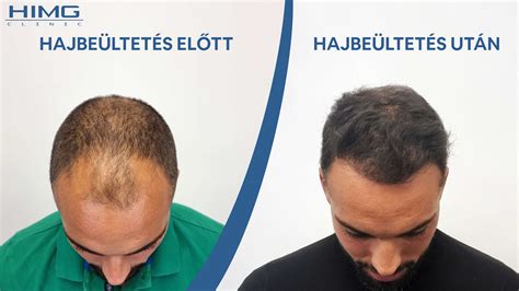 hajbeültetés folyamat vizuális ábrája