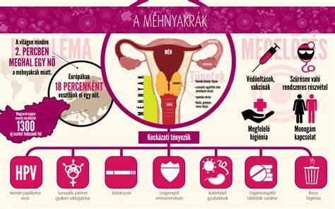 Infografika: Női húgyúti fertőzések kockázati tényezői és megelőzési lépések