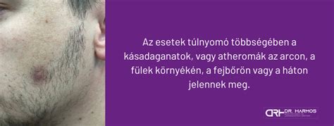 Faggyúmirigyek a fejbőrben